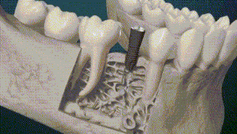 Animación del proceso de oseointegración de un implante dental